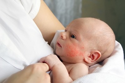 Skaza białkowa u niemowlęcia – objawy, diagnoza i leczenie