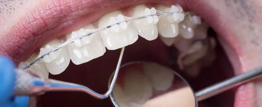 Ortodonta nie tylko dla dzieci – kiedy dorośli powinni zacząć leczenie ortodontyczne?