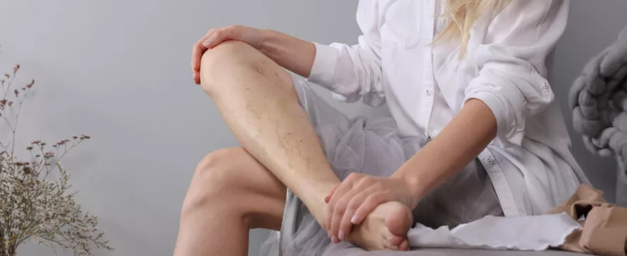 Naturalne sposoby na redukcję obrzęków nóg