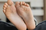 Pękające pięty - TE domowe sposoby przyniosą ulgę
