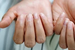 Niedob&oacute;r żelaza u kobiet i mam &ndash; objawy, badania i dieta