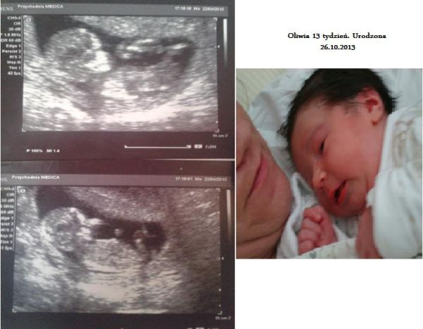 Oliwcia na USG 13 tydzień. Urodzona w 40 tyg. 26.10.2013. Na dolnym zdjęciu machała w trakcie usg rączkami i nóżkami:) Na trzecim zdjęciu zaraz po porodzie:)