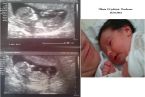 Oliwcia na USG 13 tydzień. Urodzona w 40 tyg. 26.10.2013. Na dolnym zdjęciu machała w trakcie usg rączkami i nóżkami:) Na trzecim zdjęciu zaraz po porodzie:)